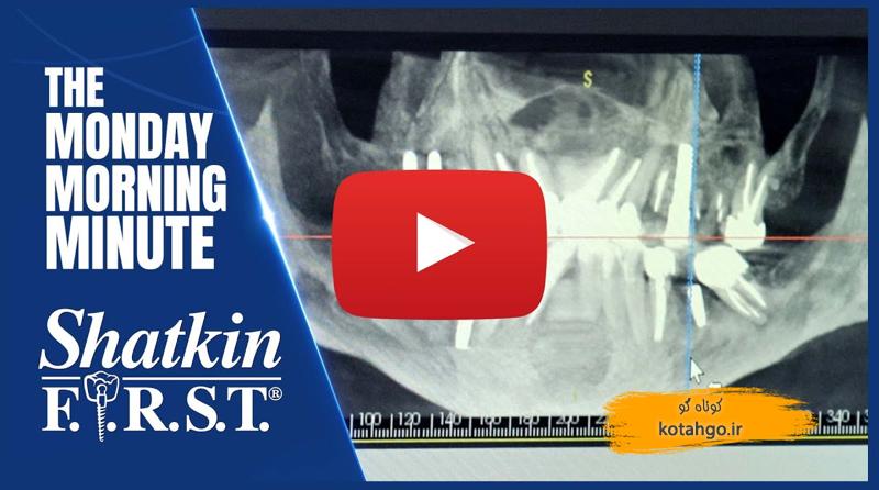 کاشت ایمپلنت فوری دندان جلو